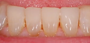 12Restored with Composite Bonding