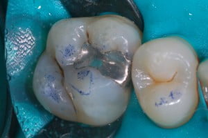 21Old Amalgam Filling