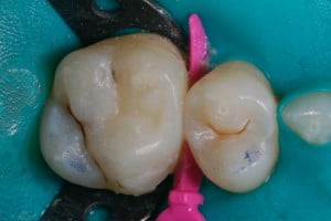 22 New White Composite Filling