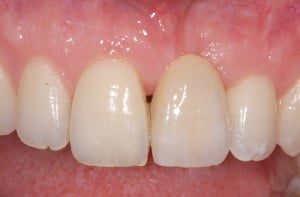 42Adhesive Bridge1(2)