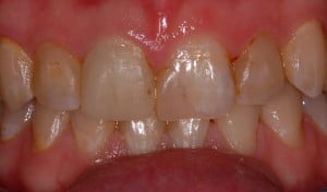 61 Heavily filled front teeth and temporary crown