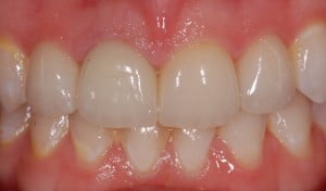 62 New Anterior crowns